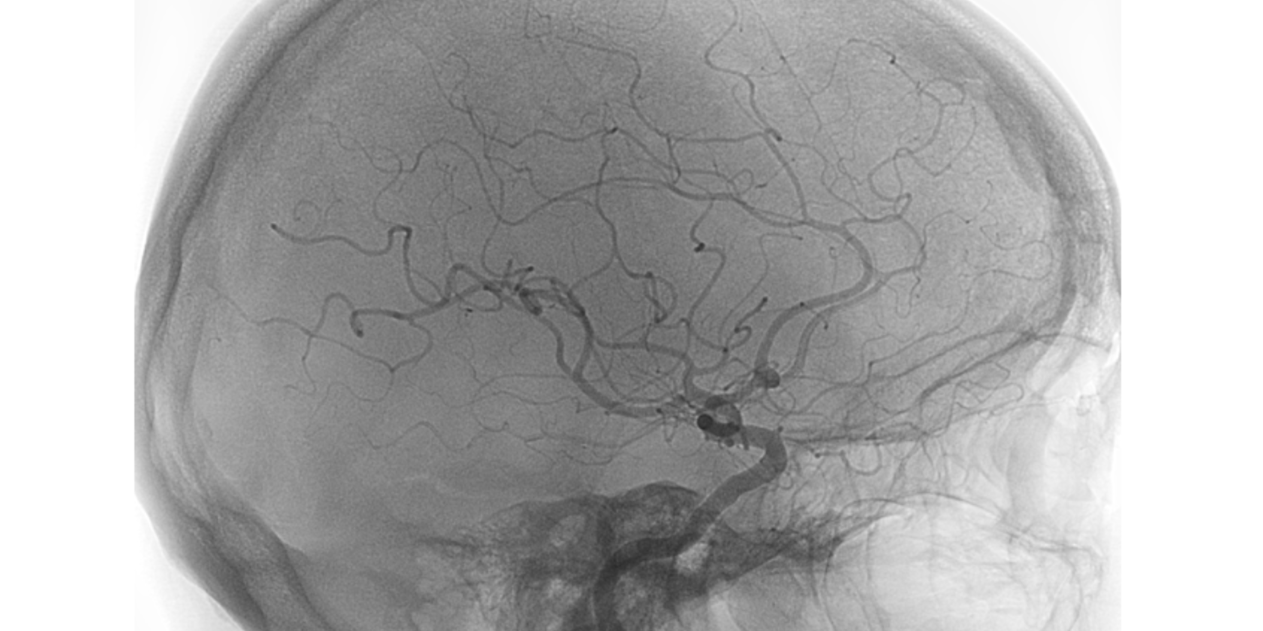 Onderzoek naar ooglensdosis bij neuro-interventionele procedures