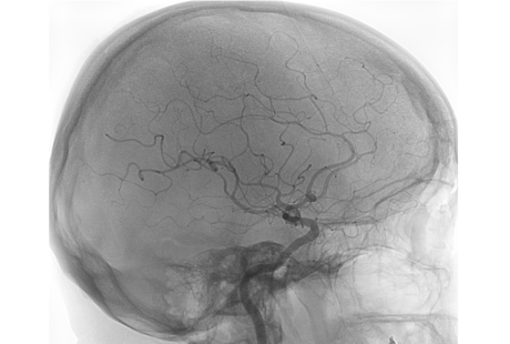 Onderzoek naar ooglensdosis bij neuro-interventionele procedures